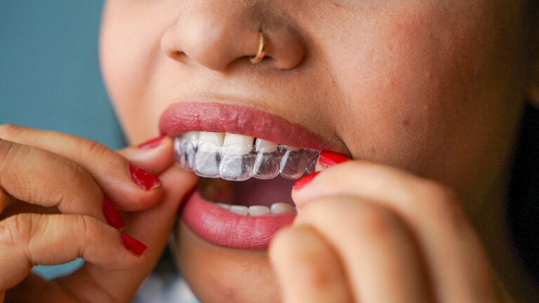 woman putting in clear aligners