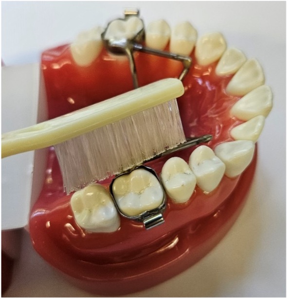 Brushing with an expander - Richmond Orthodontics