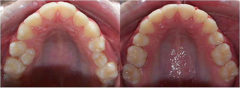 severe crowding rotated teeth